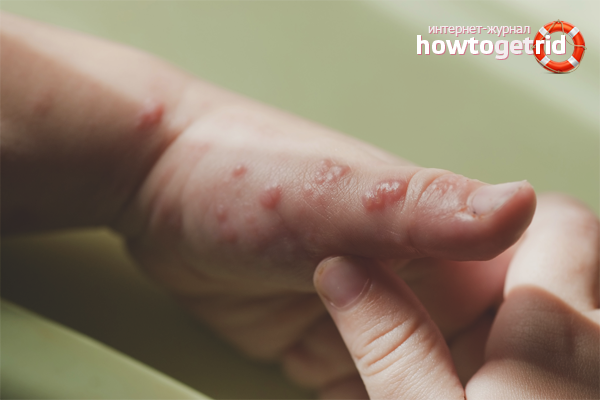 How to get rid of blisters after a burn