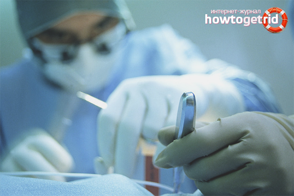 Surgical treatment of ovarian cysts