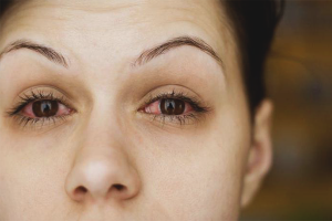 How to remove eye redness