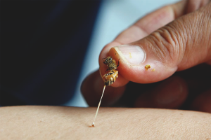 How to relieve swelling after a wasp sting