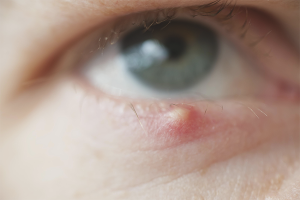 How to treat barley in the eye