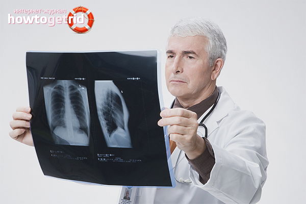 How to treat pneumonia