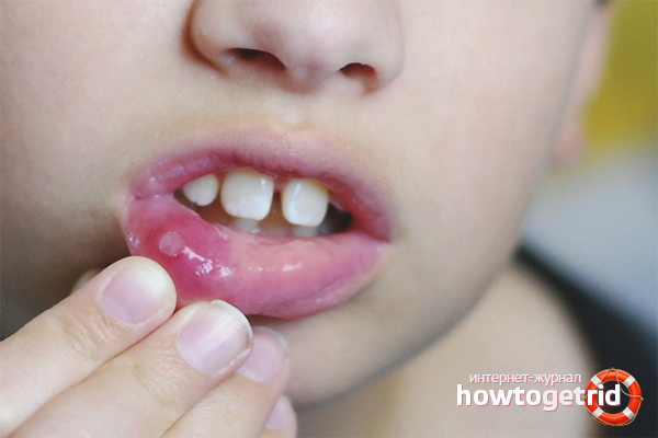 How to treat stomatitis in a child