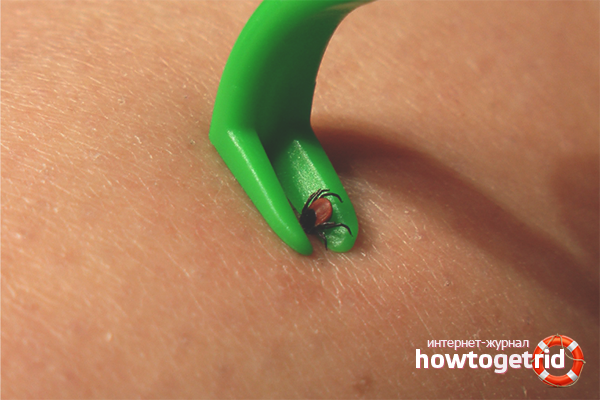 First aid for tick bites