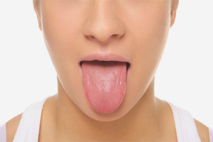 How to treat acne in the tongue