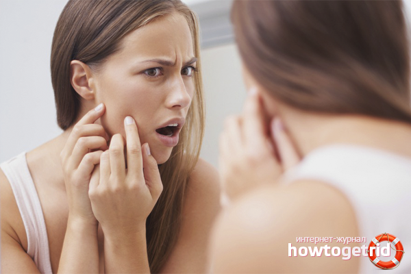 Why do acne appear on my face?