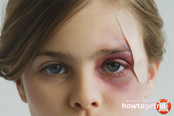 How to quickly remove a black eye