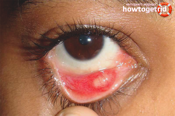 How to treat barley in the eye of a child