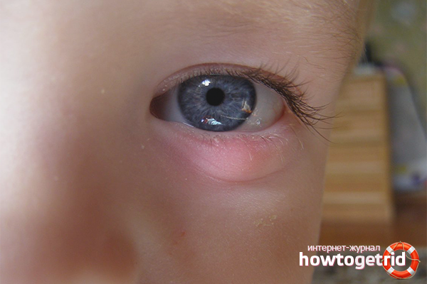 How to treat barley in a child