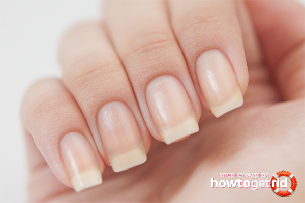 How to treat fingernail fungus