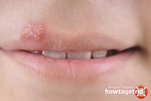 How to quickly cure a cold on the lip