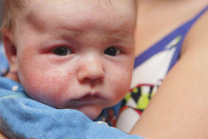 Diathesis on the cheeks of a child