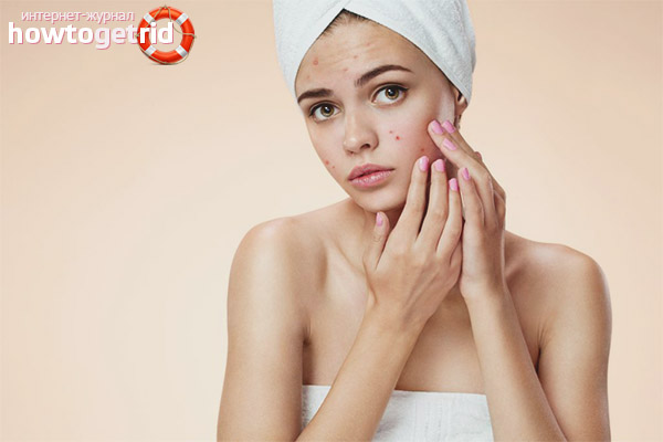 Hormonal acne in women