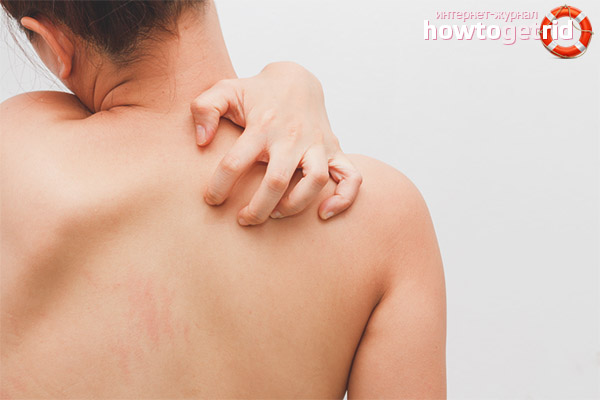 Itching throughout the body without rashes