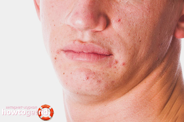 Chin Acne Treatments