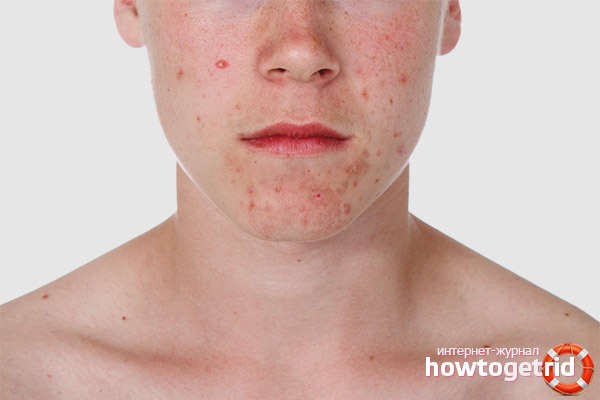 Acne on the chin in men