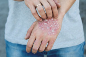 How to treat psoriasis