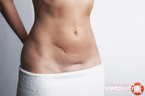 Pros and cons of cesarean section