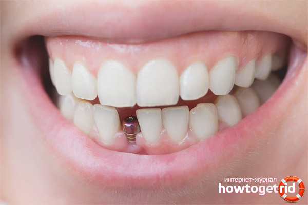 The benefits of dental implants